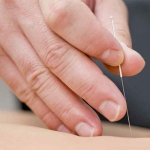 dry-needling-300x300